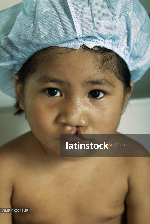 niño con labio leporino