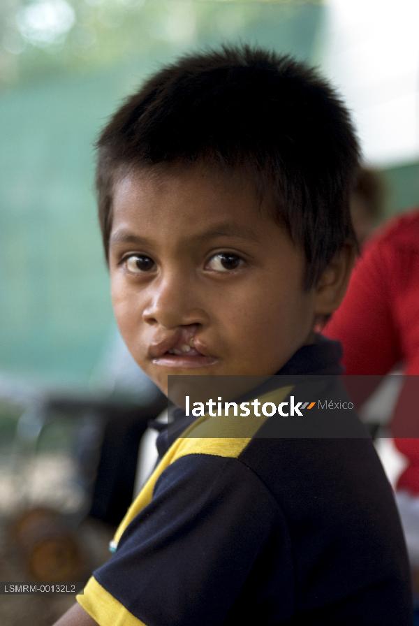 niño con labio leporino